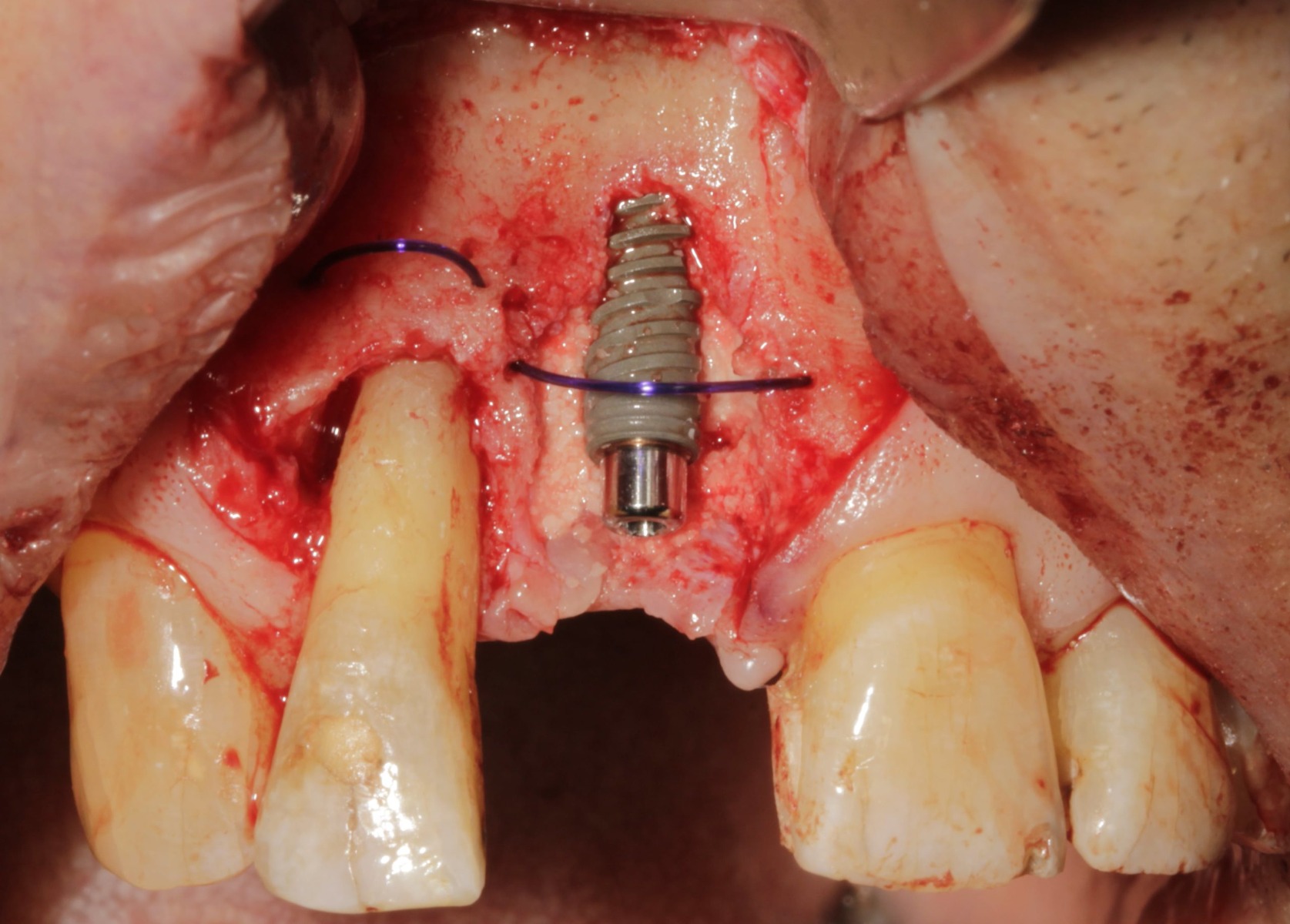 Placement of 2-0 PDS tenting sutures to create “dome device”