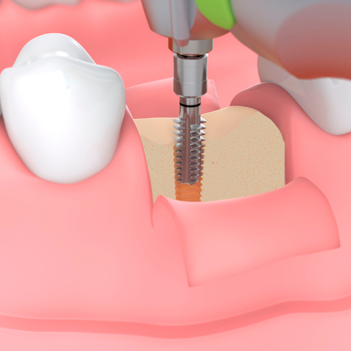 Implant insertion with thread cutter function