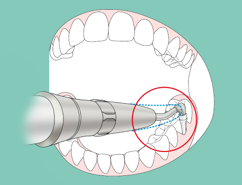 NSK Perio-Mate Biofilm Eraser - Narrow Nozzle