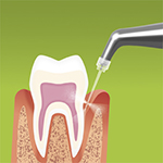 Biofilm management of periodontal pockets