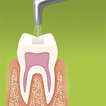 Cleaning of cavity margins prior to etching