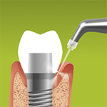 Cleaning of fissures prior to sealing