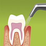 Removal of subgingival biofilm