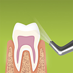 Removal of supragingival biofilm