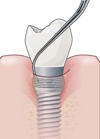 Debridement of narrow implant threads, right-oriented.