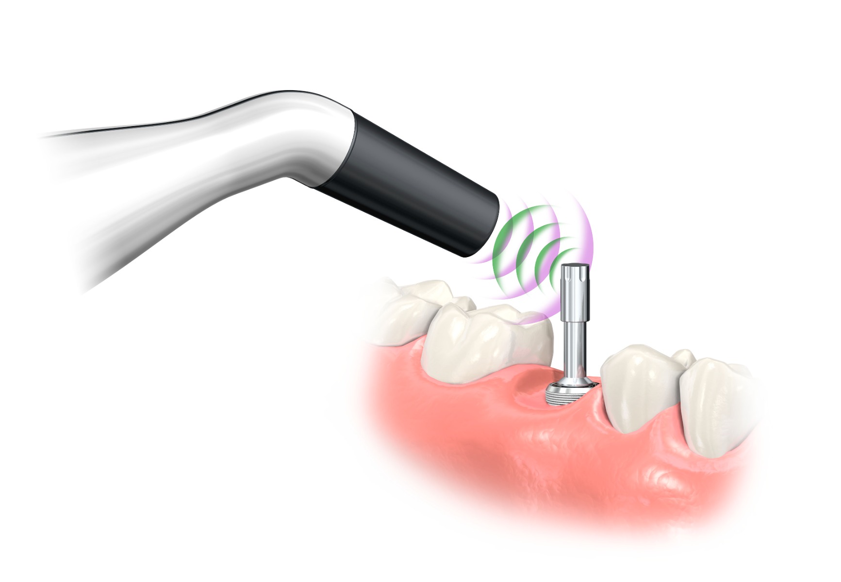 PenguinRFA Osseointegration Monitor scanning MulTipeg