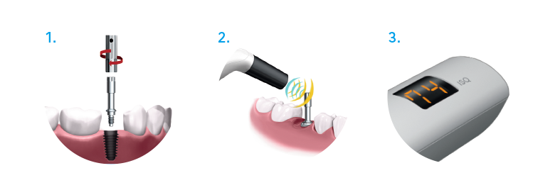 Three Steps to using the Osseo 100+ Osseointegration Monitor