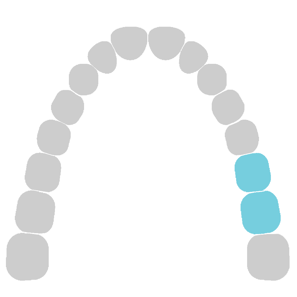 Upper Jaw - Left Molars