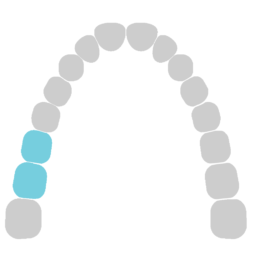 Upper right molars