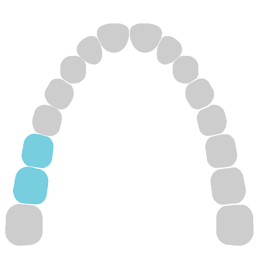 Upper Jaw - Molars, Right