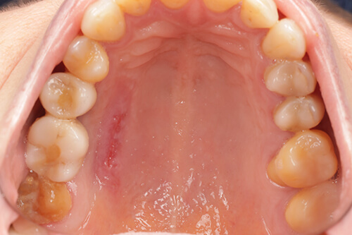 Patient wears stent for 1 week