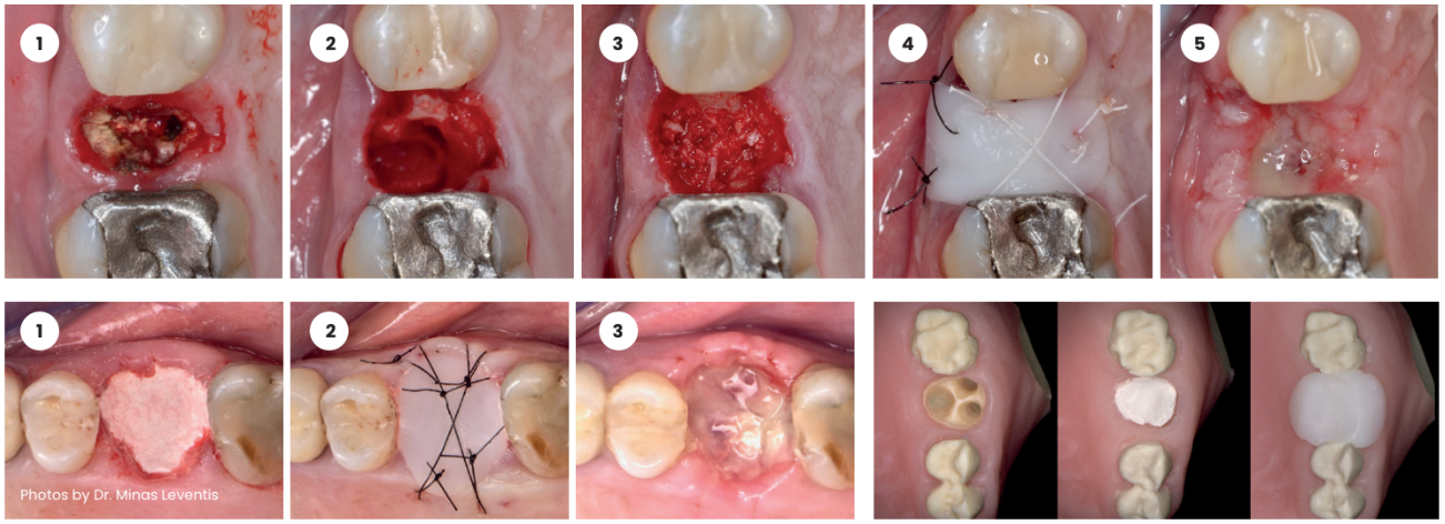 Elemental protects bone graft material & optimises healing conditions