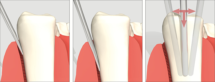 Luxator Short Periotome Technique