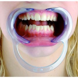 Clear Spandex Cheek and Lip Retractor in use