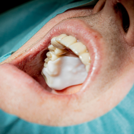 Elemental in situ in a patient's mouth