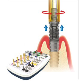 Neobiotech Implant Removal Kit and diagram of failed dental implant being removed