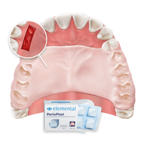 Elemental PerioPlast Antibacterial Wound Dressing
