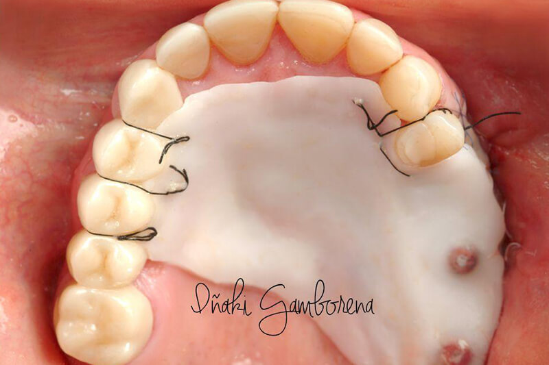 The stent was placed on a complicated healing site with underlying conditions.