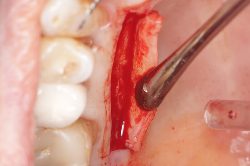 The free gingival graft is harvested. No sutures are placed whatsoever.
