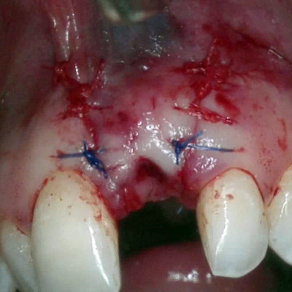 ANTERIOR_IMPLANT_PLACEMENT_GRAFT