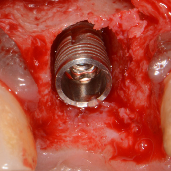 Anterior_Ridge_Study_Image