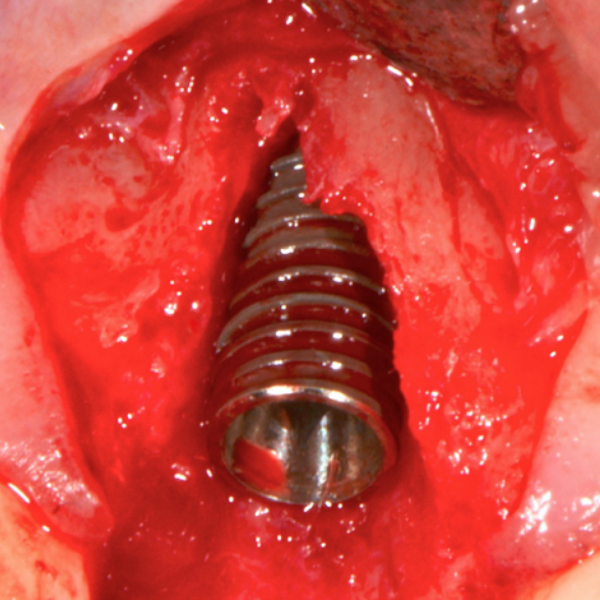 BUCCAL_DEFECT_CASE_STUDY