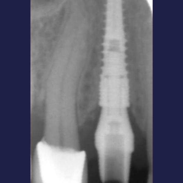 BUCCAL_DEFECT_LONG_TERM_BONE_IMPROVEMENT