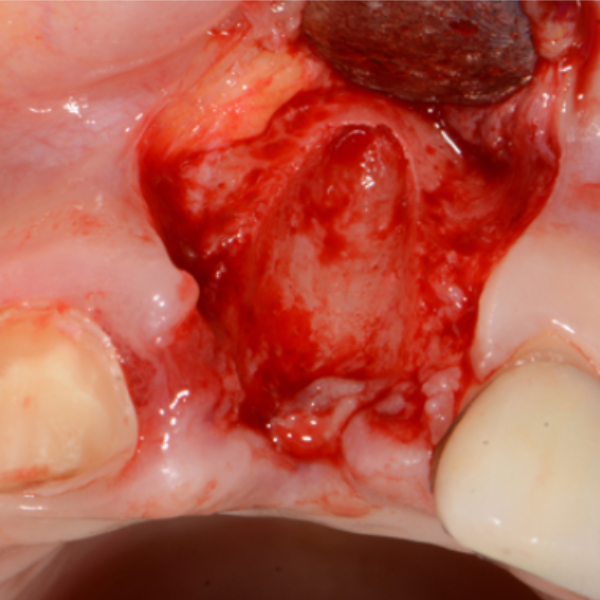 DENTAL_BONE_GRAFT_UPPER_LEFT_CENTRAL