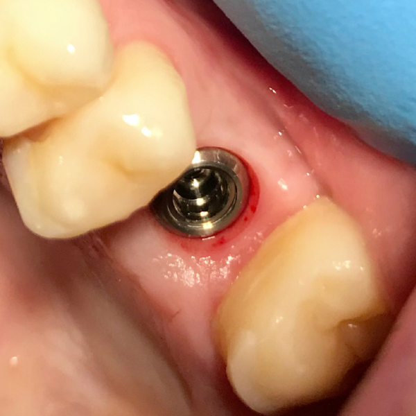 DENTAL_IMPLANT_WITH_SIMULTANEOUS_SINUS_GRAFT