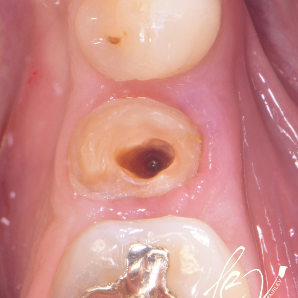 EARLY_LOADING_OF_DENTAL_IMPLANTS