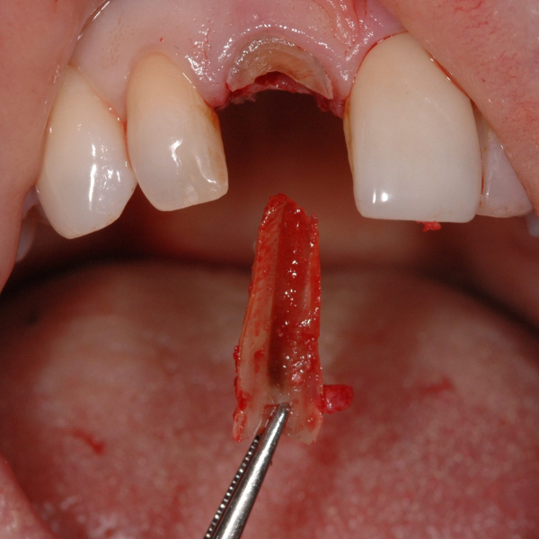 IMMEDIATE_IMPLANT_PLACEMENT_WITH_PARTIAL_EXTRACTION_THERAPY