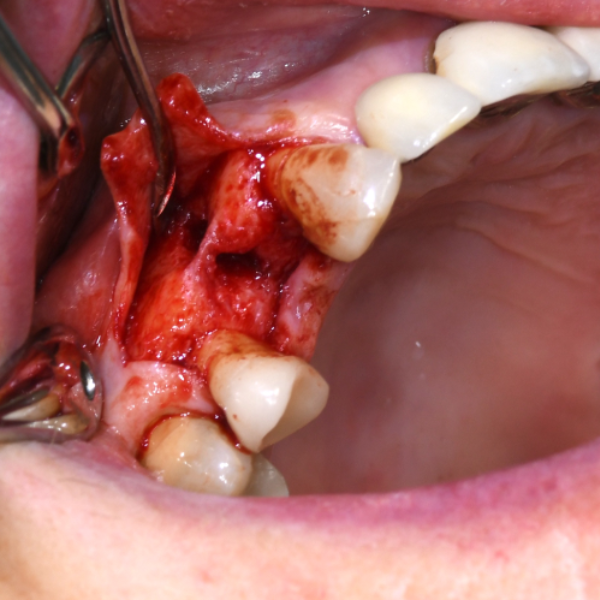 Immediate_Dental_Implant_Placement