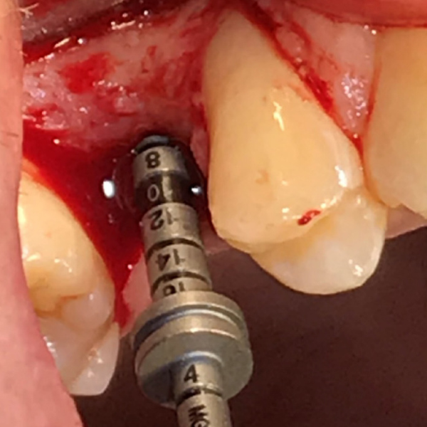 LATERAL_WINDOW_SINUS_AUGMENTATION