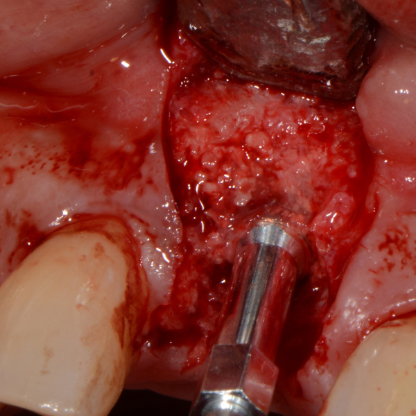 LONG_TERM_BUCCAL_GRAFT