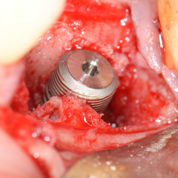 LOWER_LEFT_FIRST_MOLAR