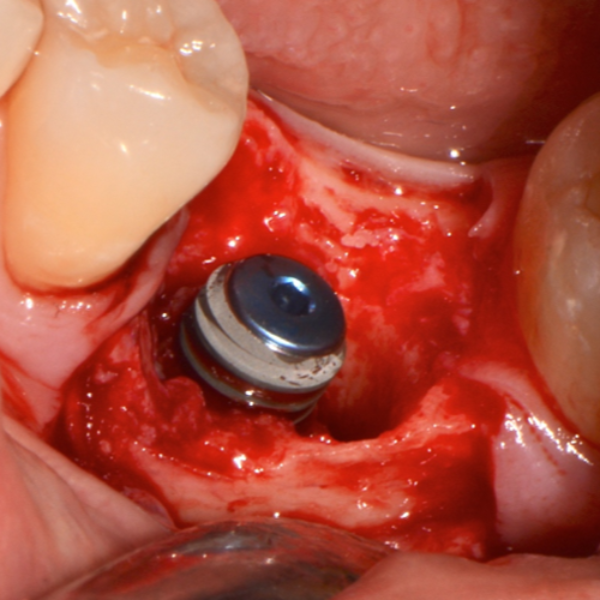 LOWER_MOLAR