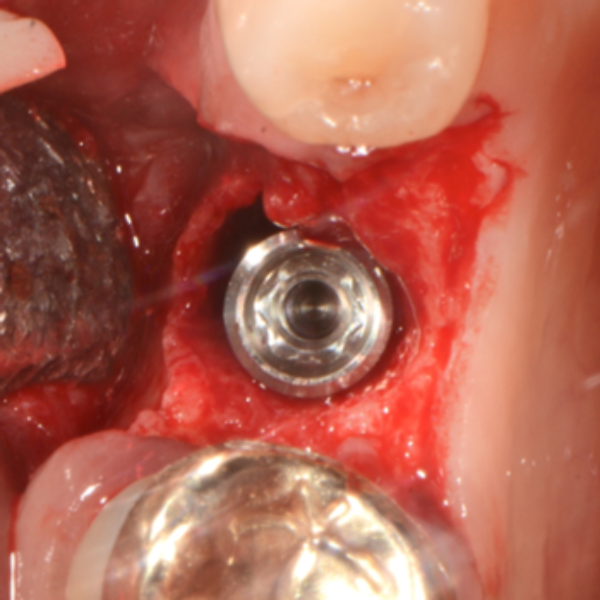 LOWER_PRE-MOLAR