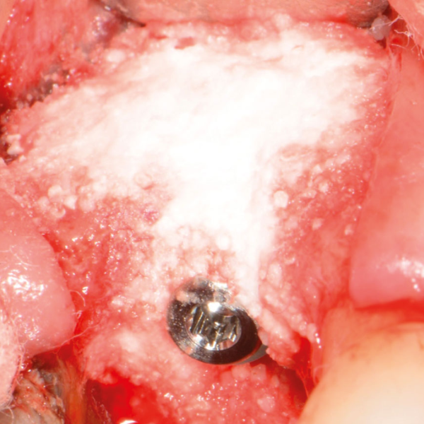 MULTIPLE_APICECTOMY_UPPER_PRE_MOLAR