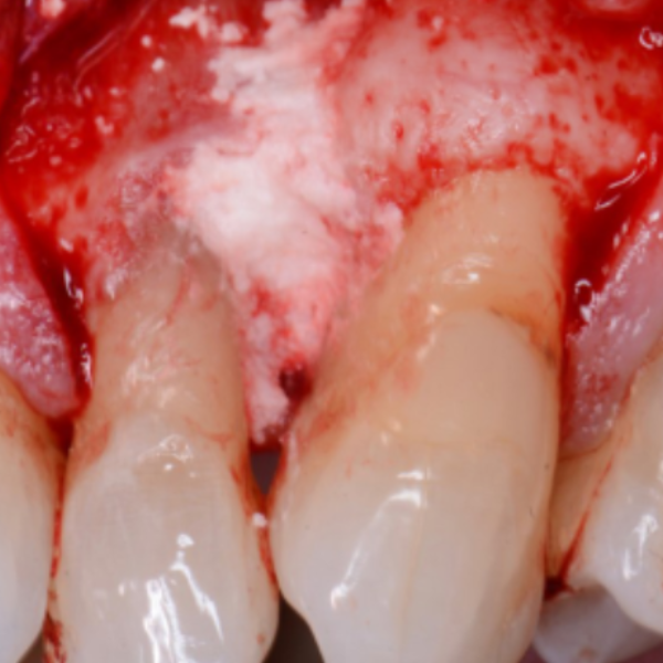 Peridontal_Grafting