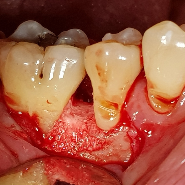 Periodontal_Defect_Regeneration