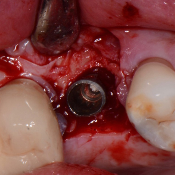 REMOVAL_OF_IMPLANT_SINUS_LIFT_AND_IMPLANT_REPLACEMENT