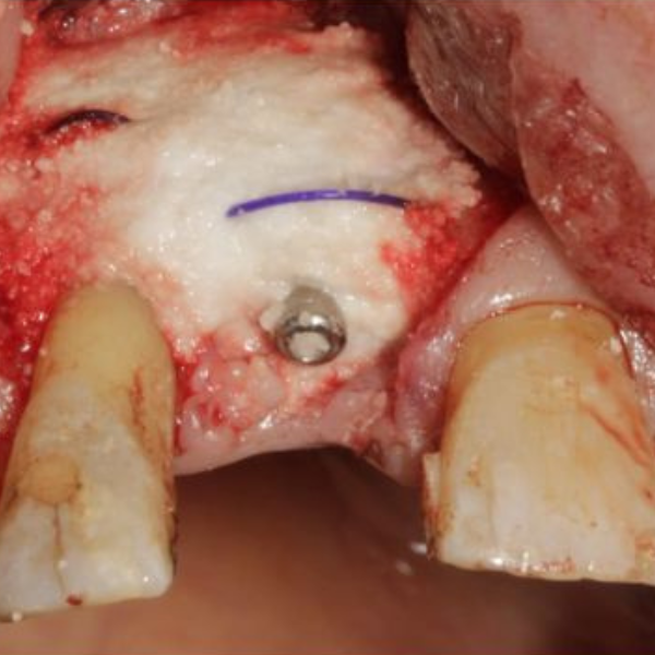 Resorbable_Suture_Tenting