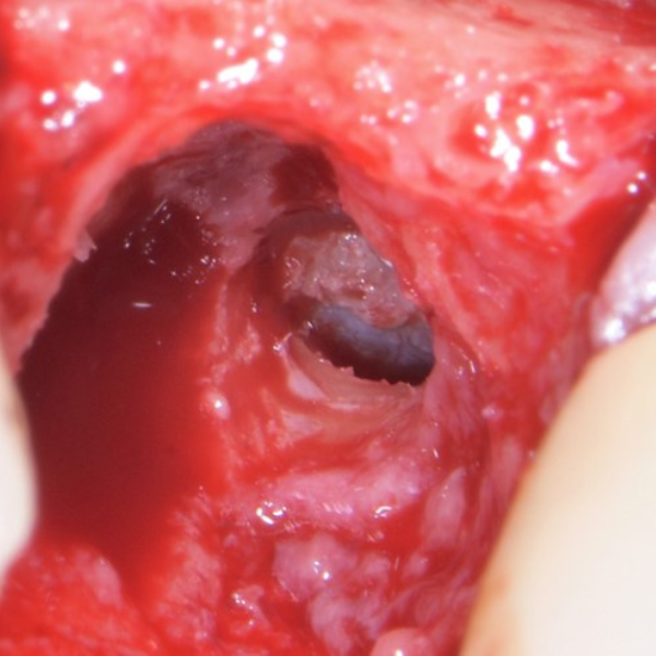 SINUS_AUGMENTATION_CRESTAL_APPROACH_WITH_DASK