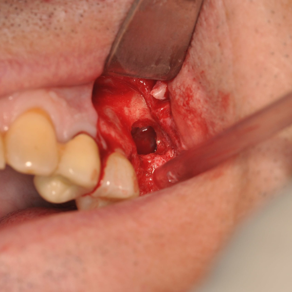 SINUS_LIFT_WITH_IMMEDIATE_PLACEMENT