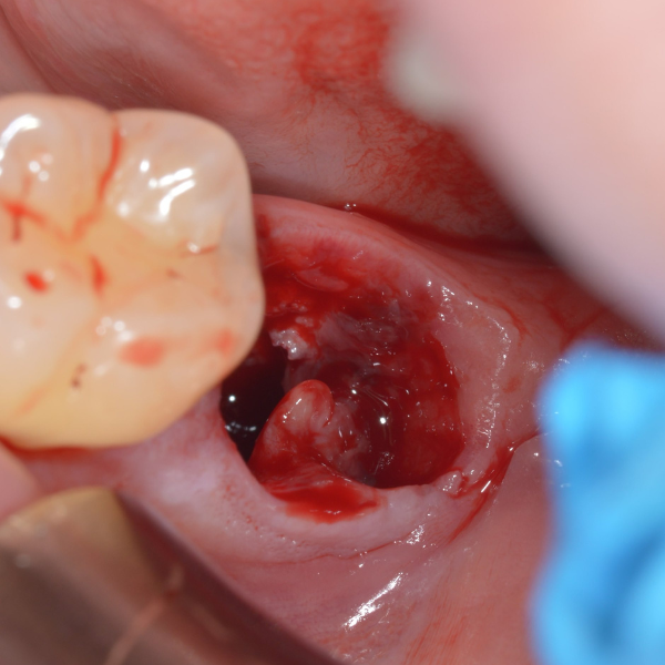 SOCKET_GRAFTING_WITH_DELAYED_IMPLANT_PLACEMENT