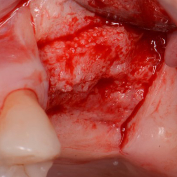 SOCKET_GRAFT_AND_SINUS