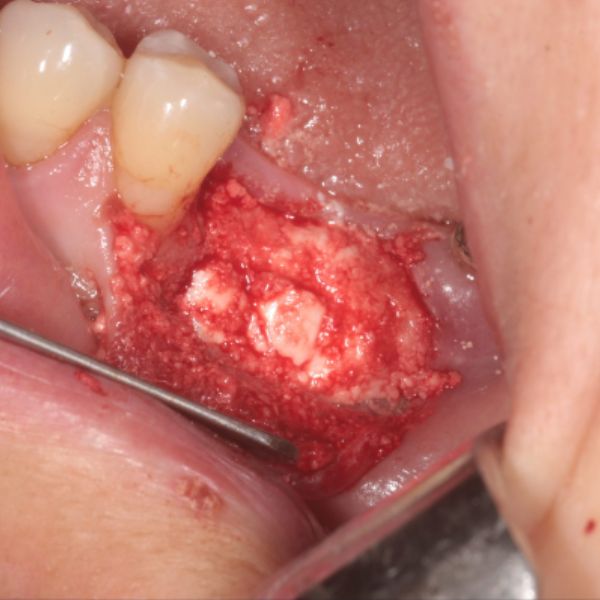 Simultaneous_Graft_and_Implant_Placement_LL6