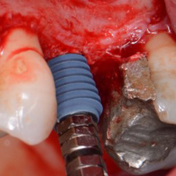 Sinus_Augmentation_-_Lateral_Window