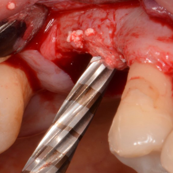 Sinus_Lift_and_Periodontal_Grafting