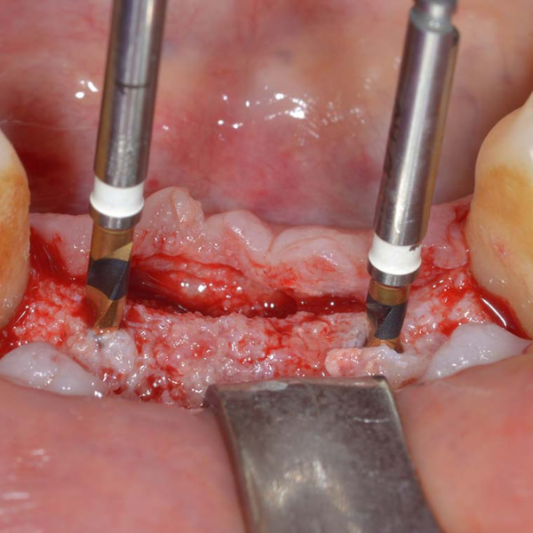 Sinus_Lift_with_Immediate_Placement